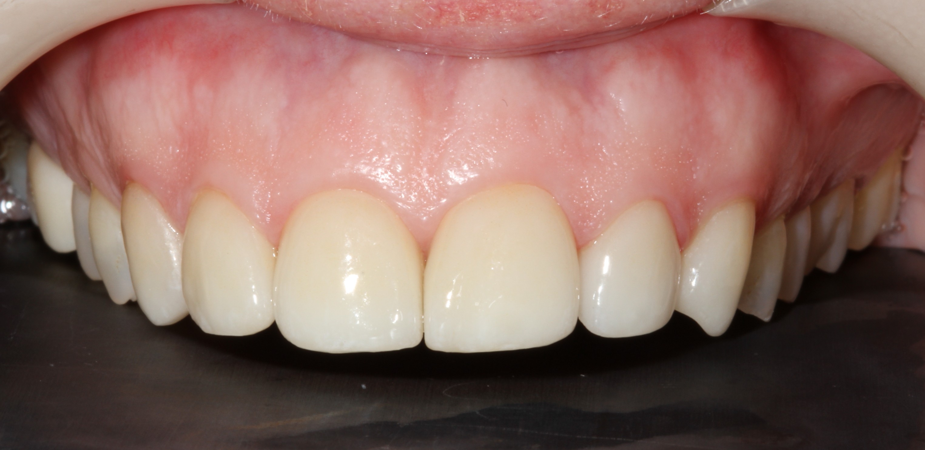 Patient smile after cosmetic dental treatment result 1