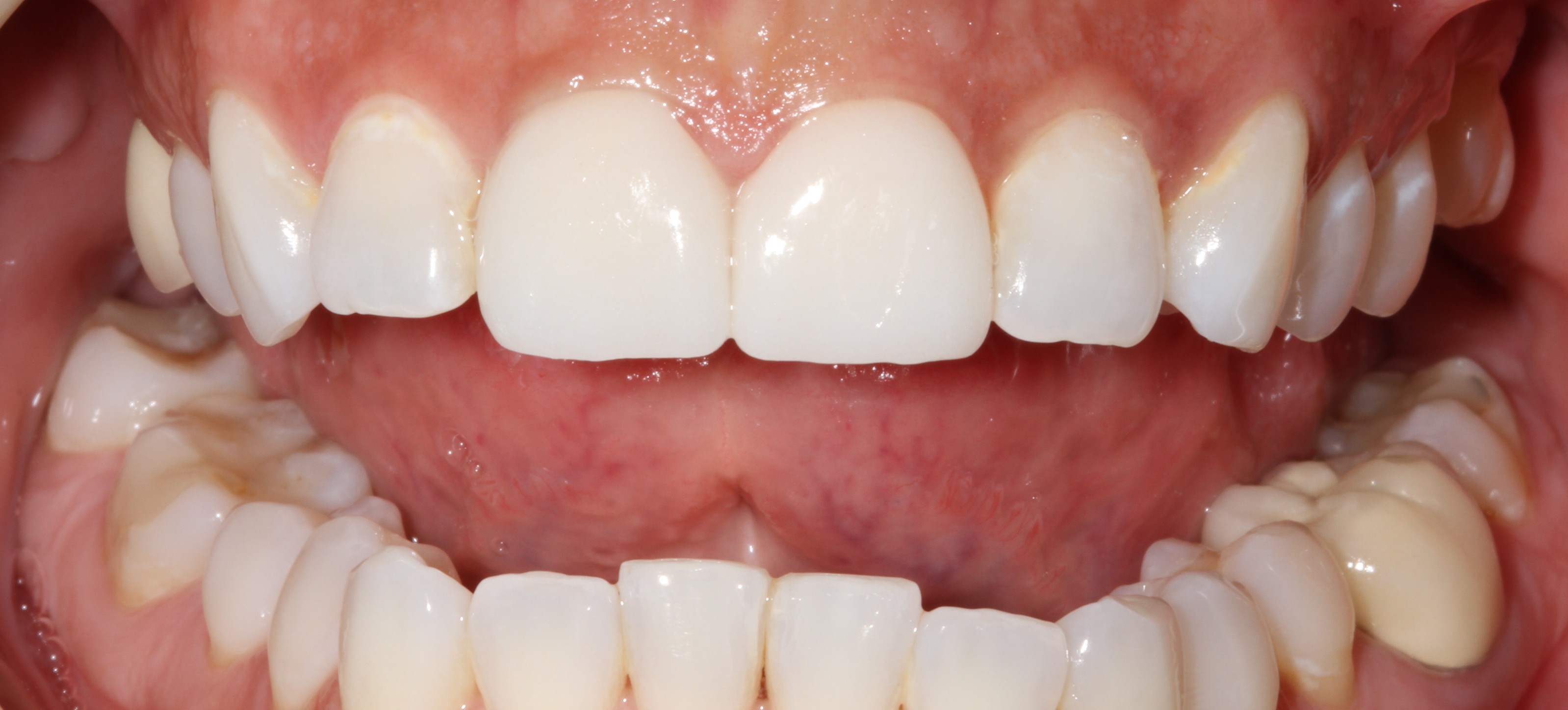Patient smile after cosmetic dental treatment result 2