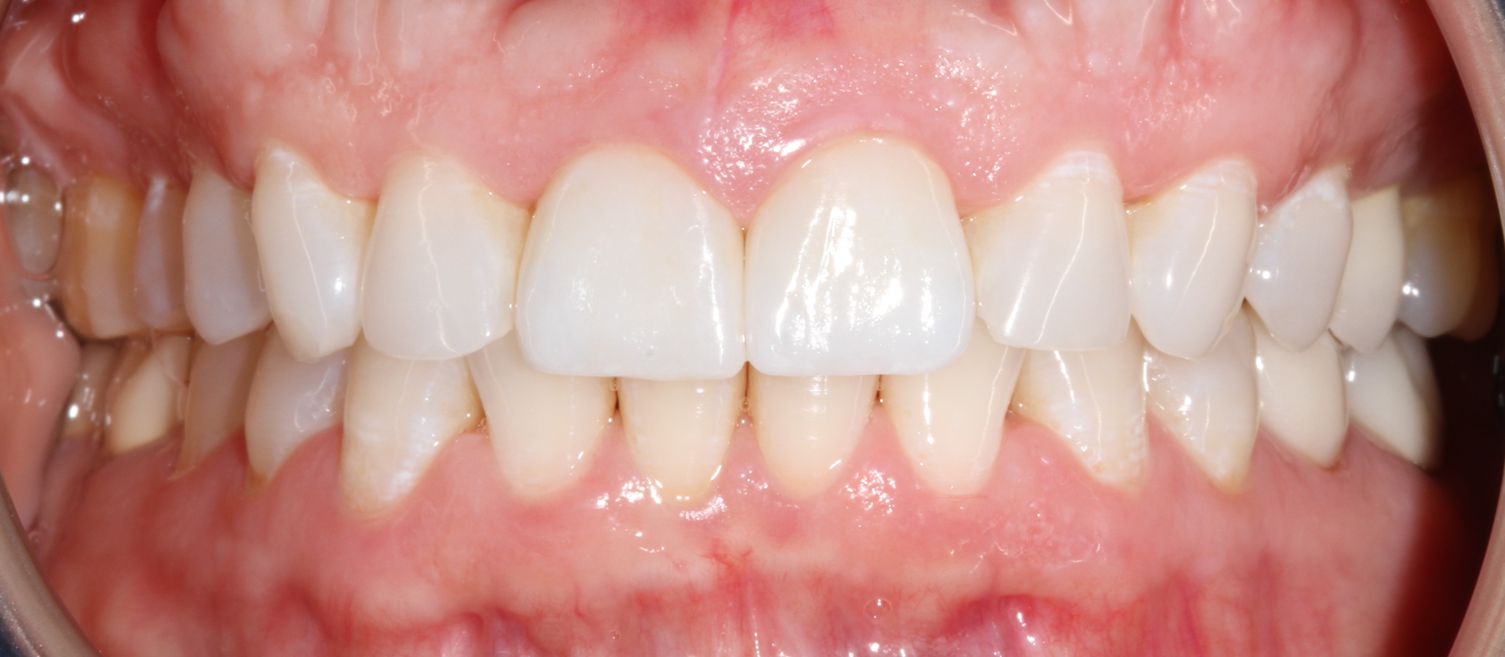 Patient smile after cosmetic dental treatment result 3