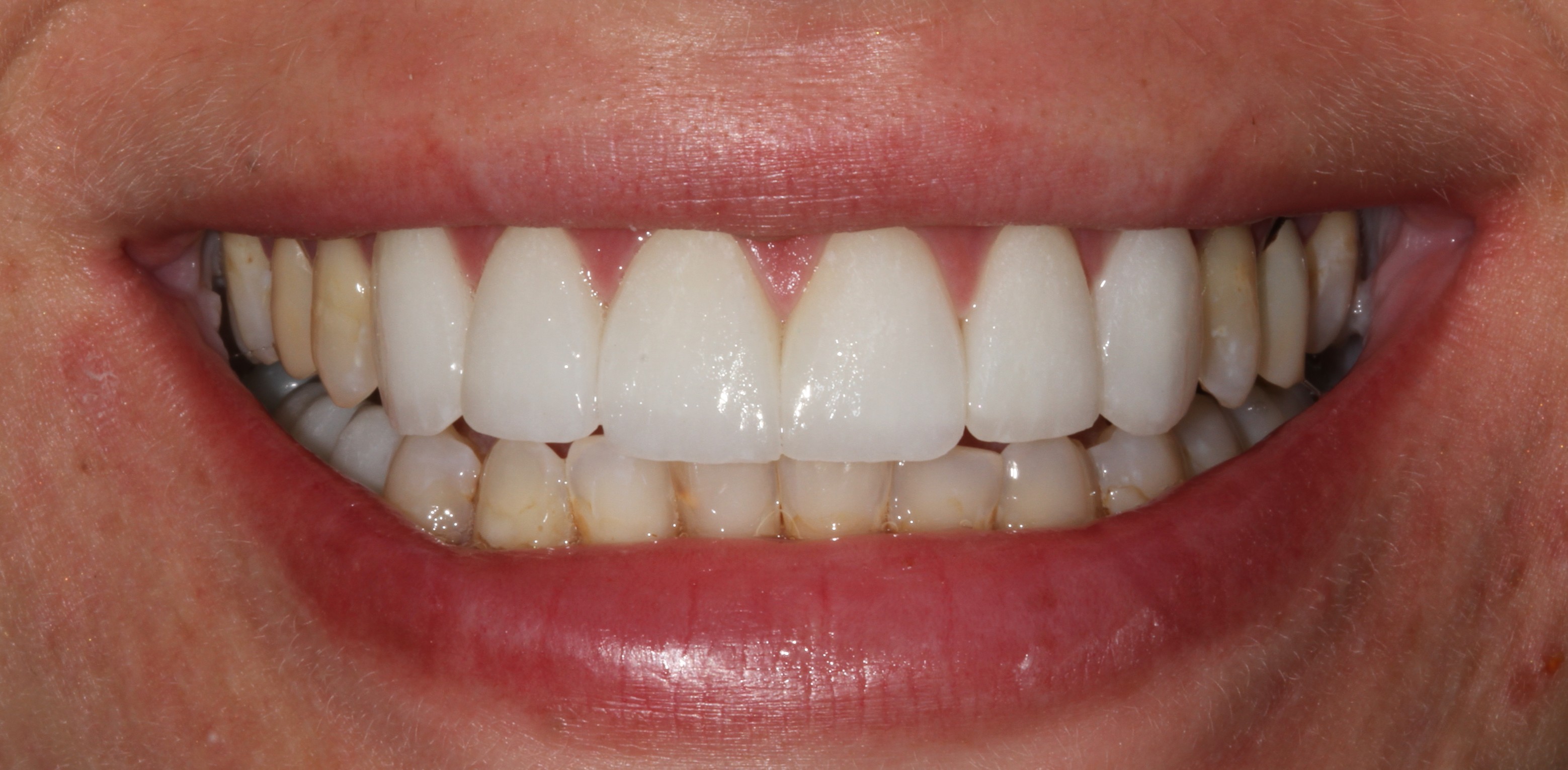 Patient smile after cosmetic dental treatment result 4