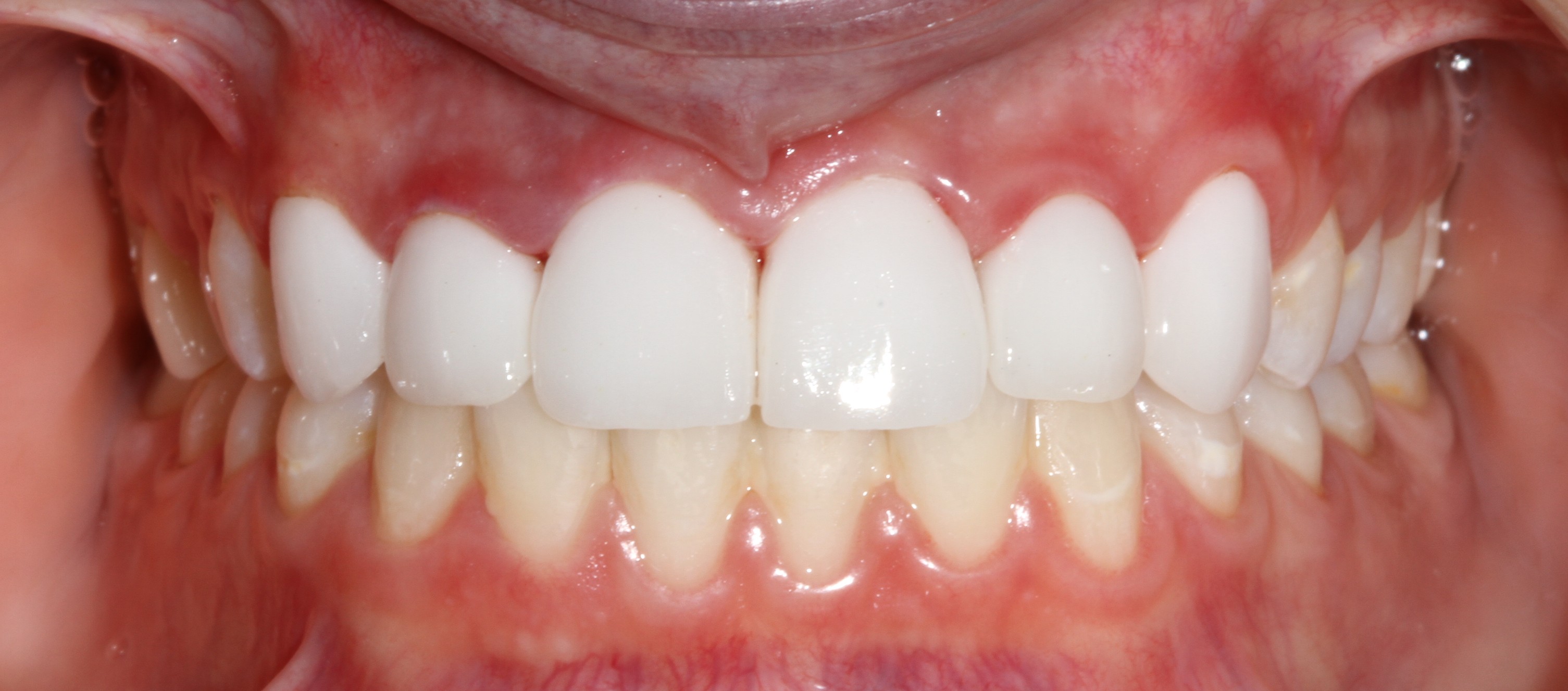 Patient smile after cosmetic dental treatment result 5