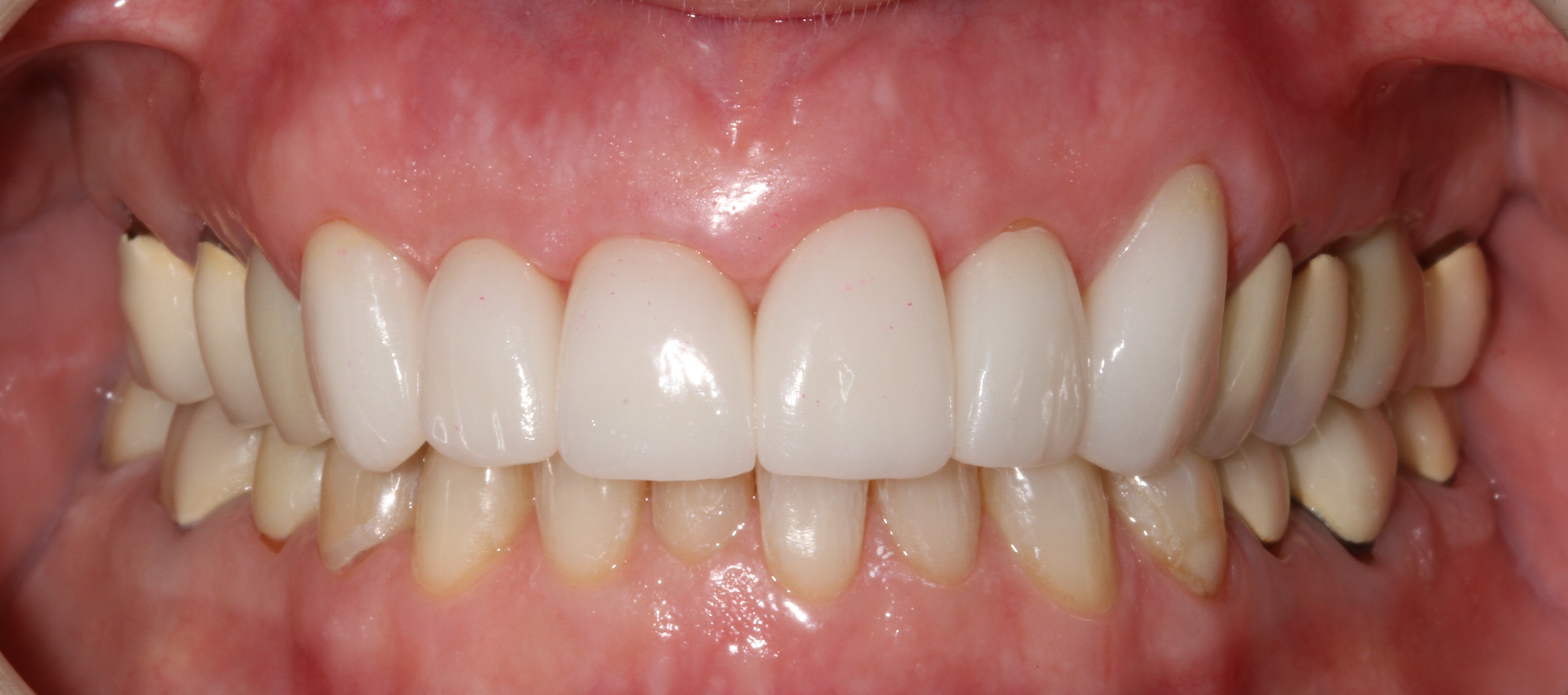 Patient smile after cosmetic dental treatment result 6