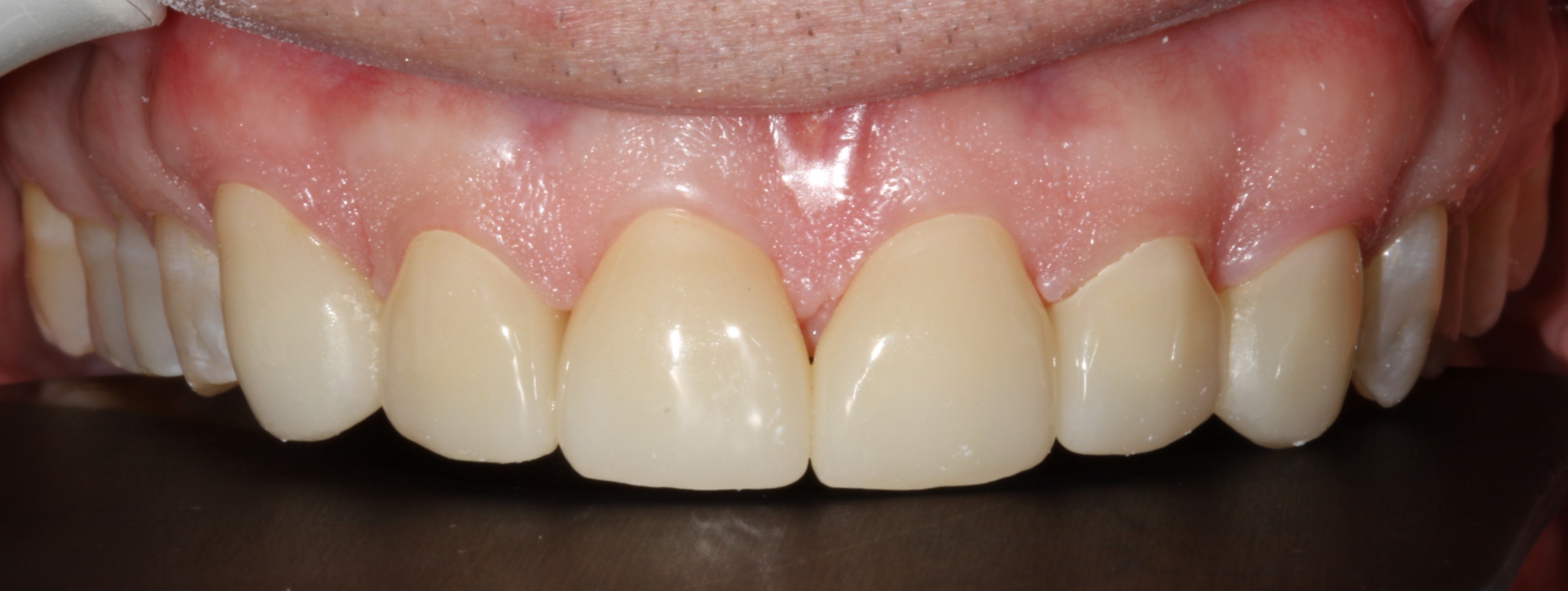 Patient smile after cosmetic dental treatment result 7