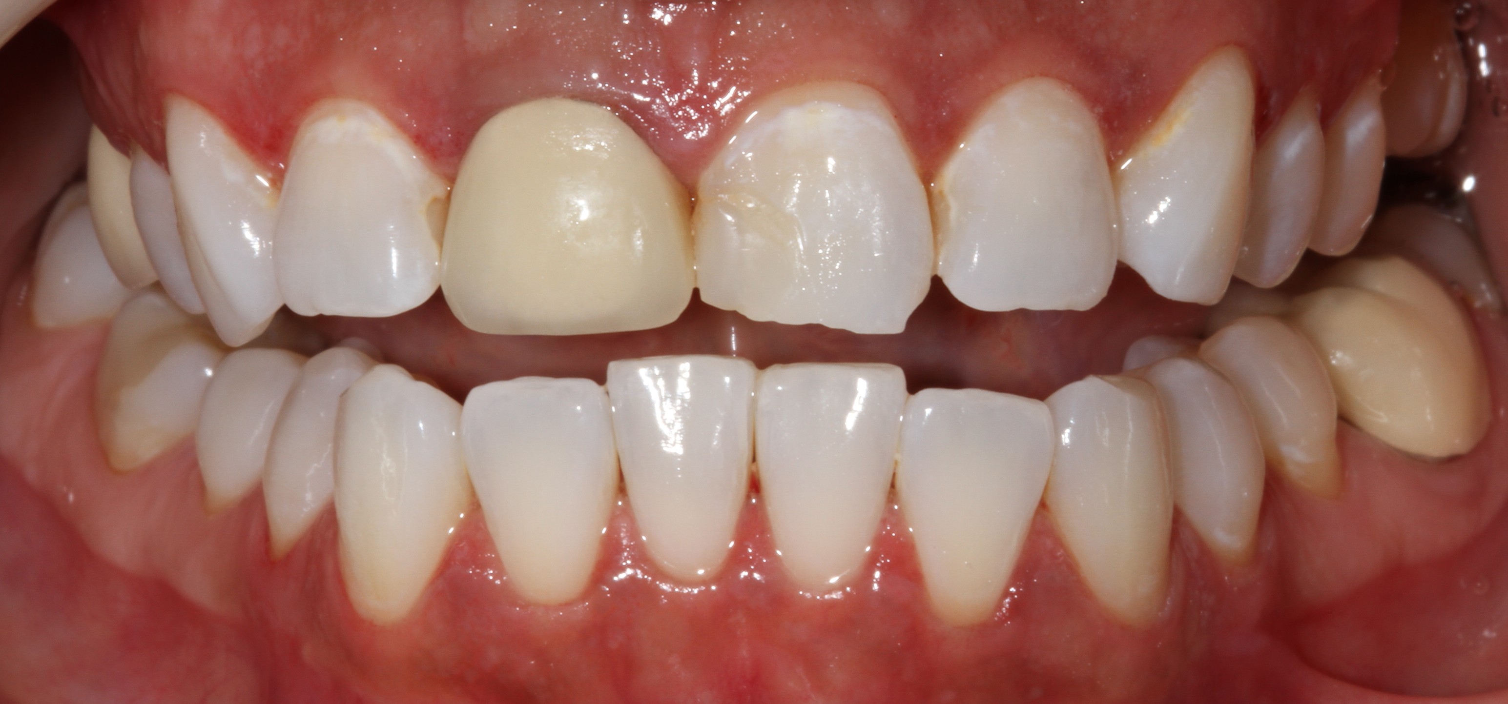 Patient smile before cosmetic dental treatment result 2