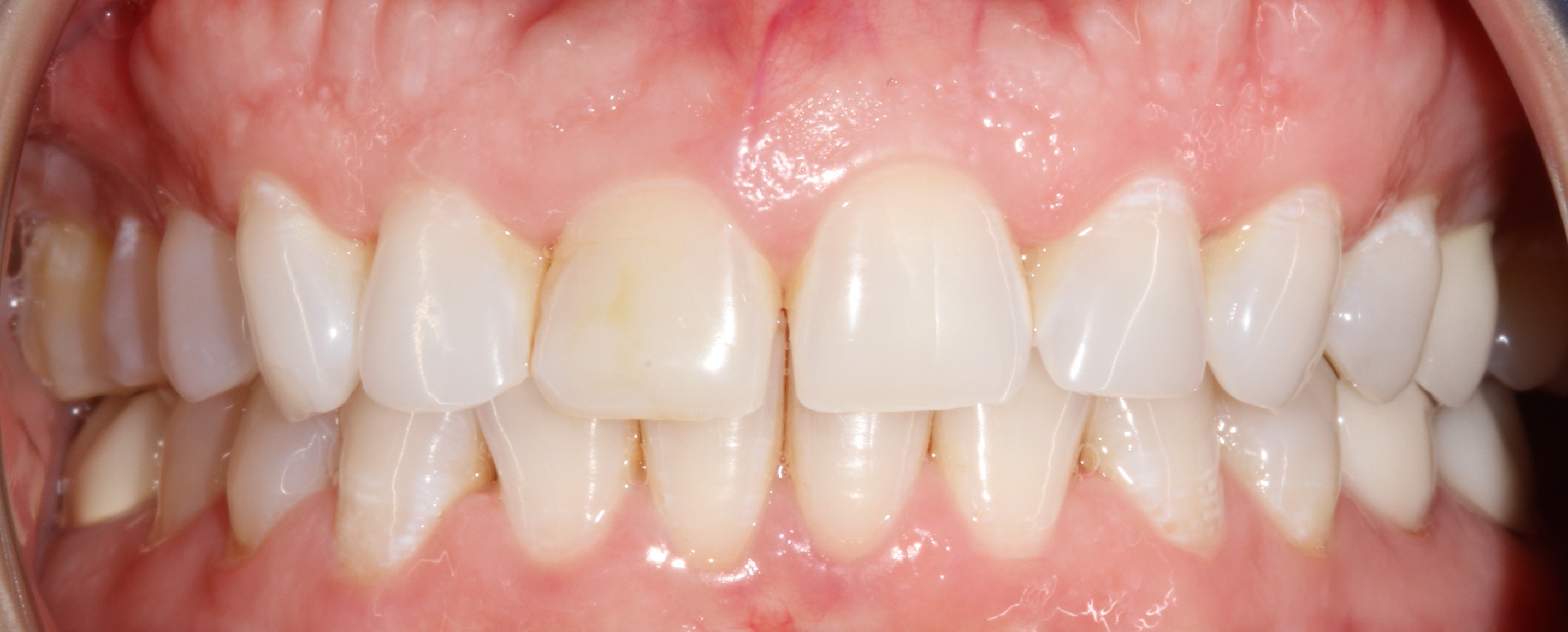 Patient smile before cosmetic dental treatment result 3