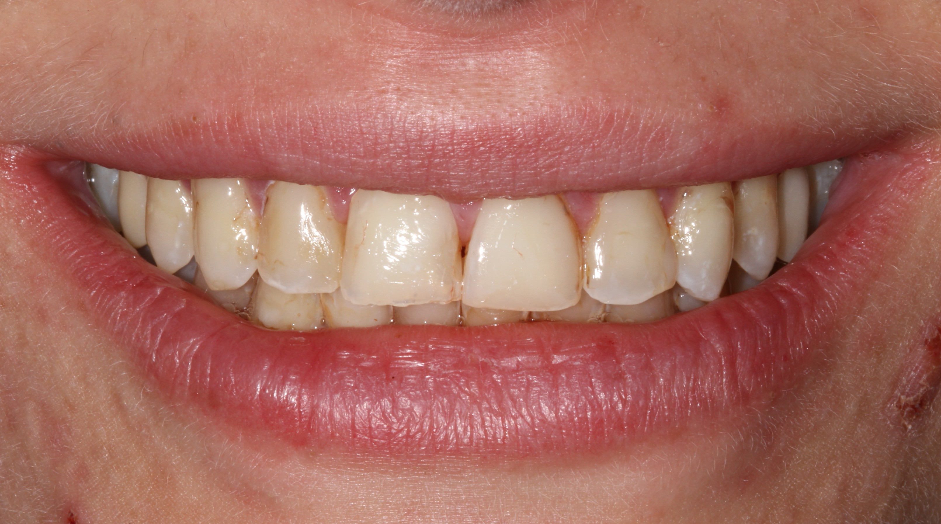 Patient smile before cosmetic dental treatment result 4