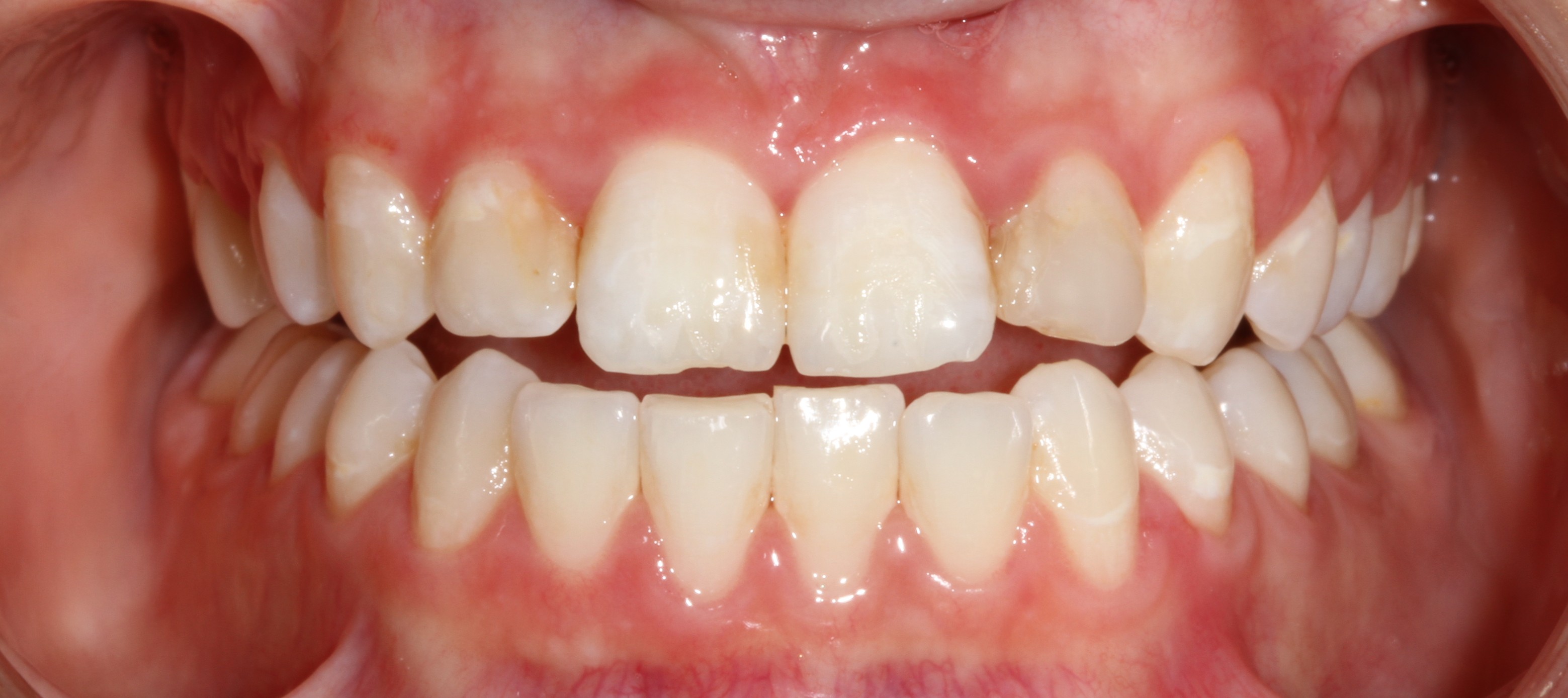 Patient smile before cosmetic dental treatment result 5