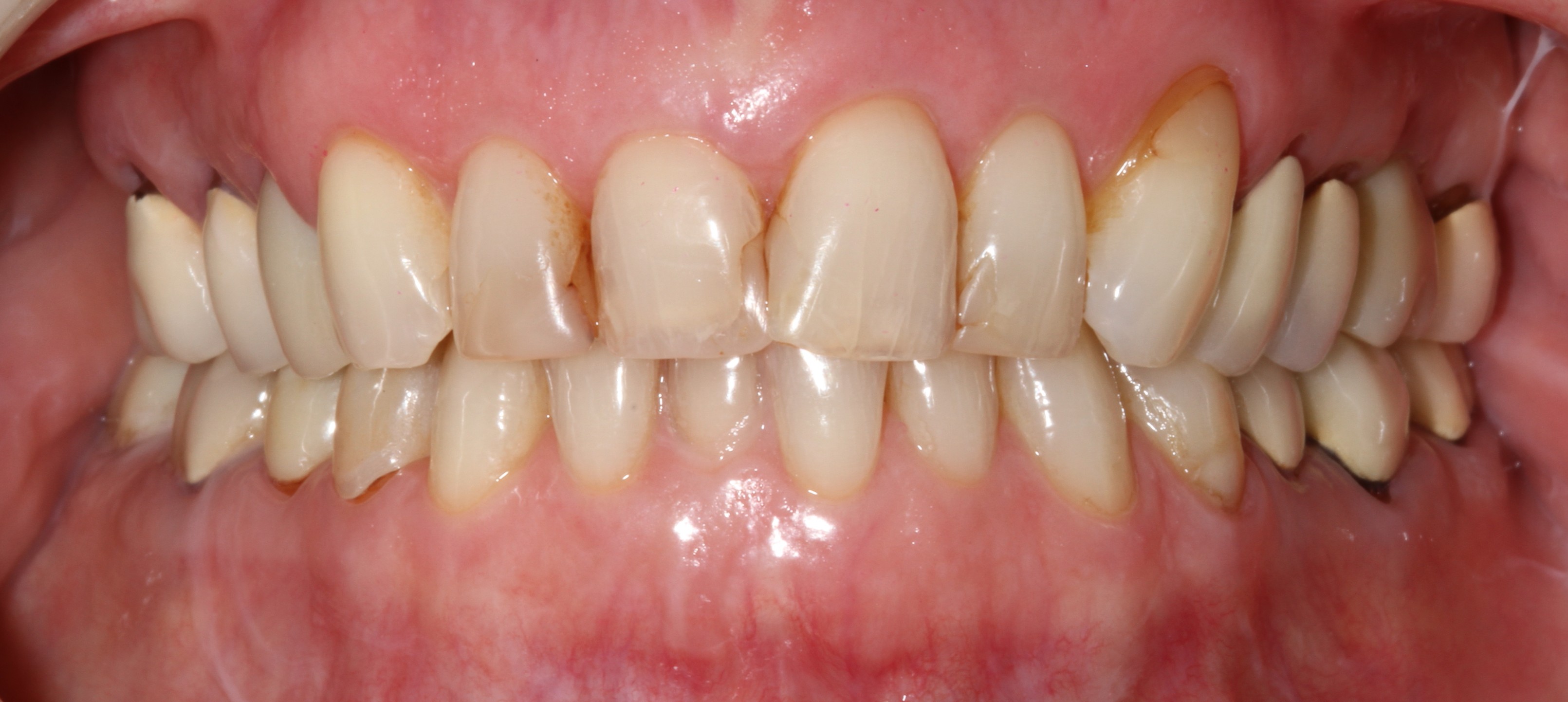 Patient smile before cosmetic dental treatment result 6