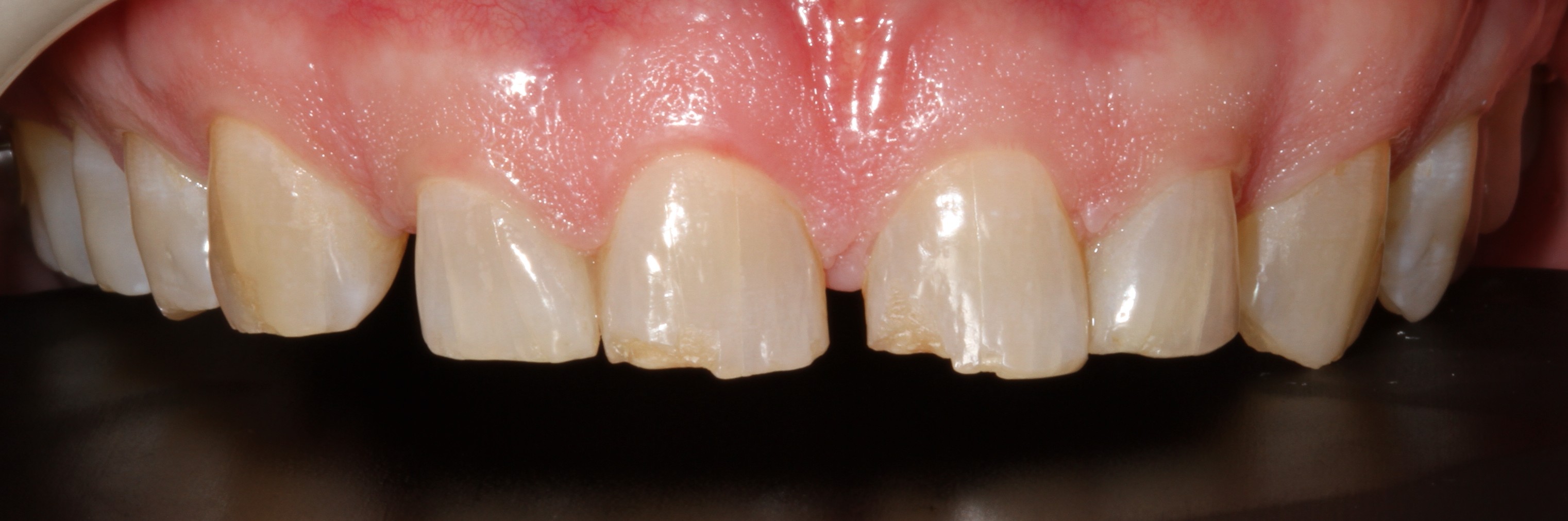 Patient smile before cosmetic dental treatment result 7