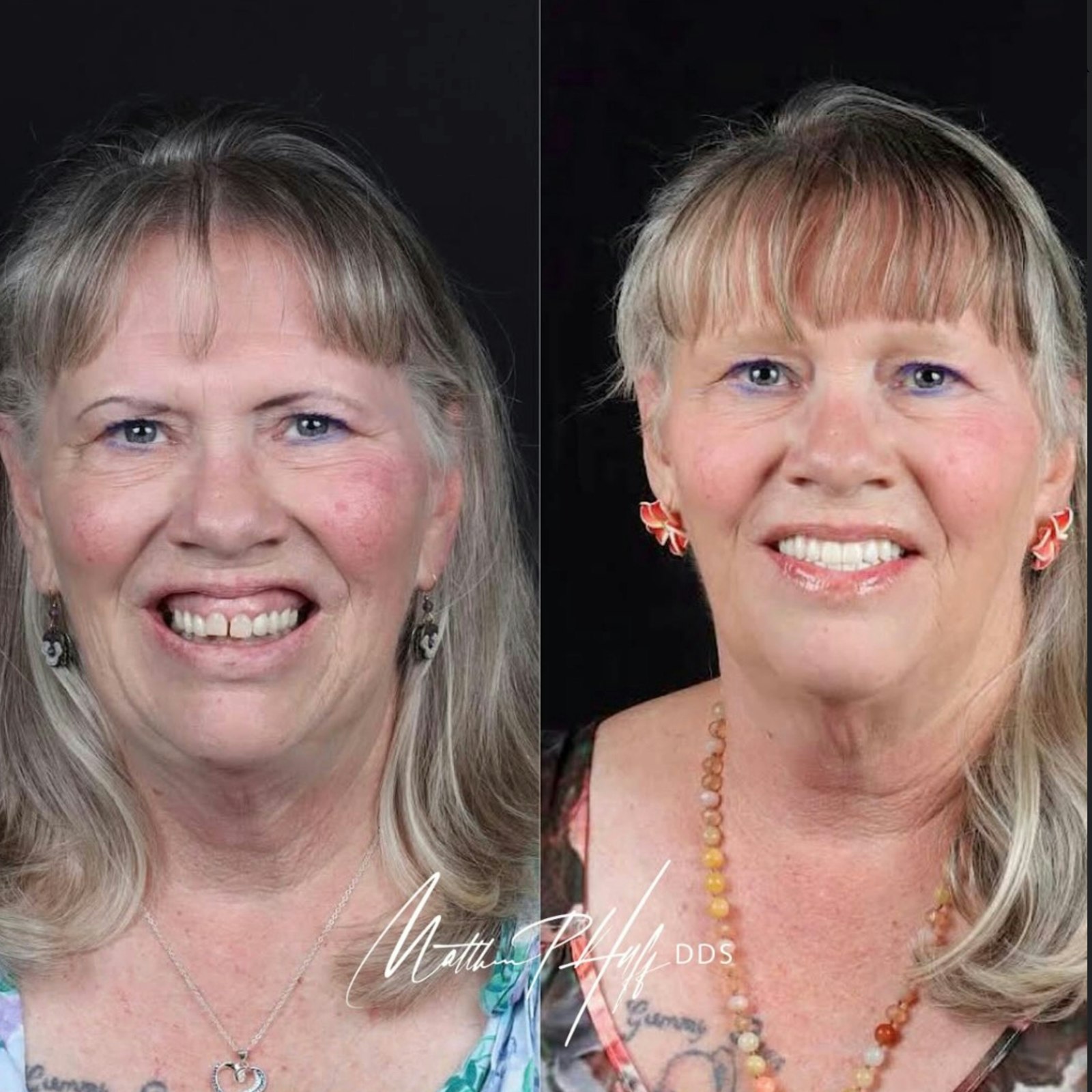 Before-and-after cosmetic dentistry smile transformation