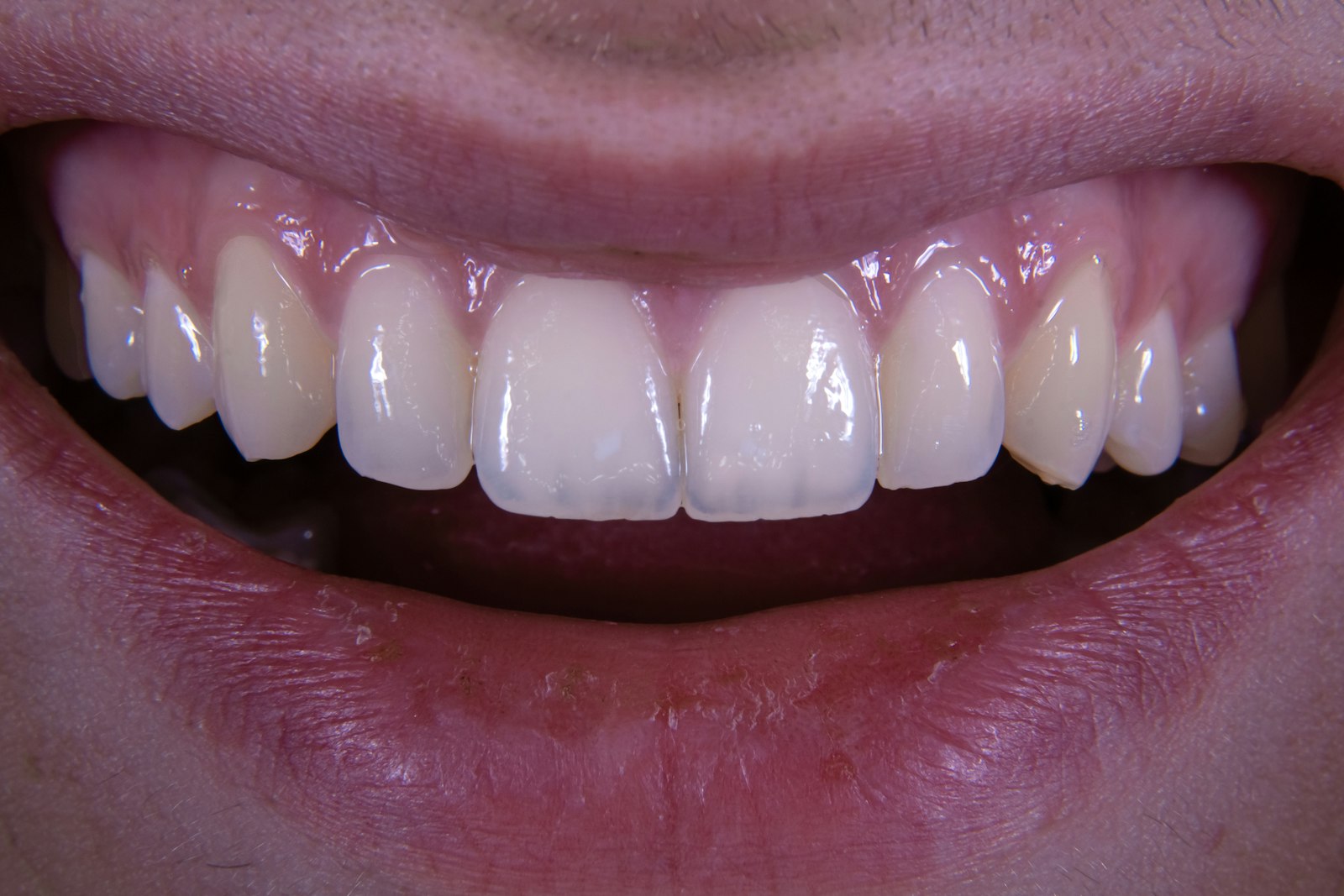 Close-up of a smile with a missing tooth area relevant to dental bridges
