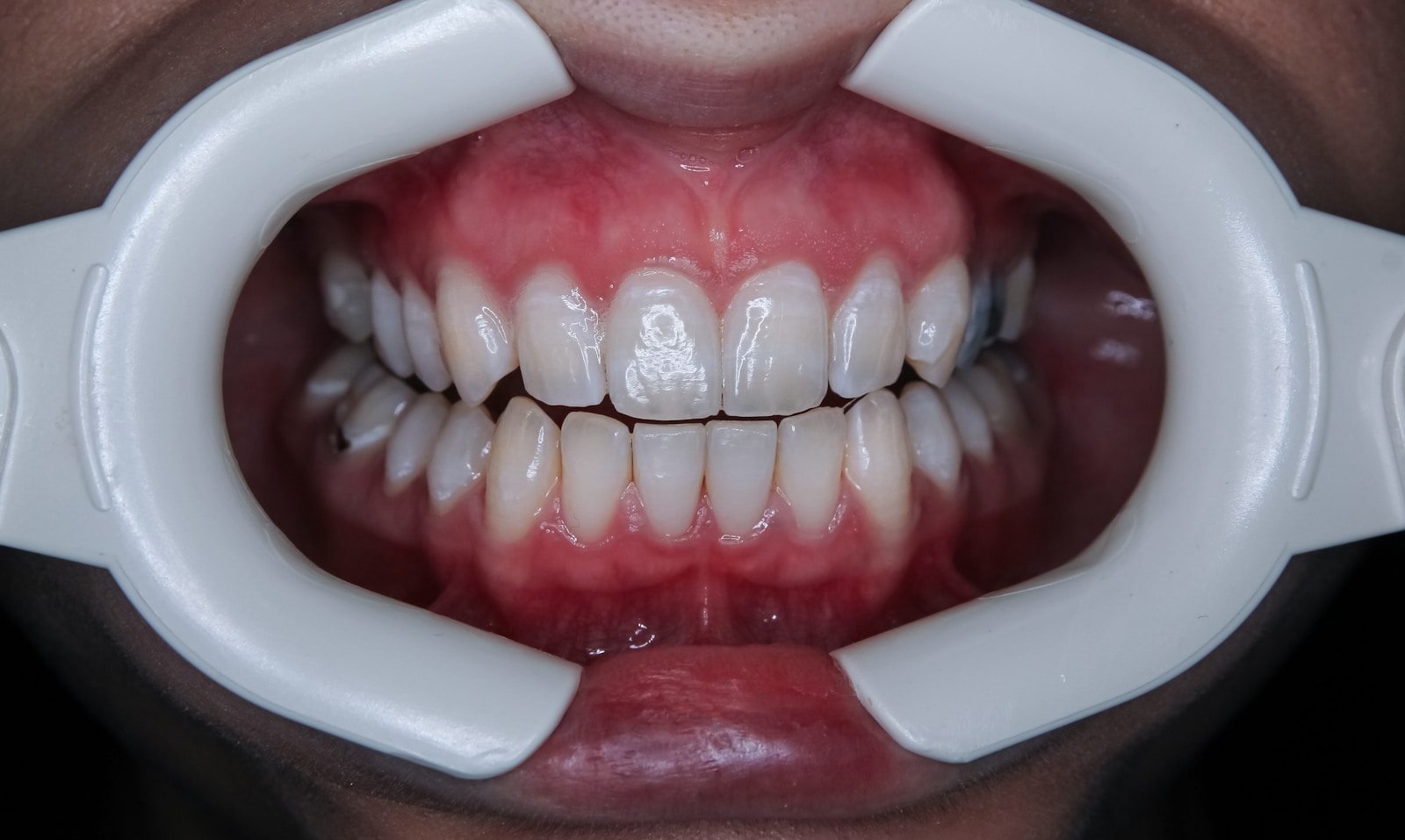 Bright close-up smile representing professional teeth whitening