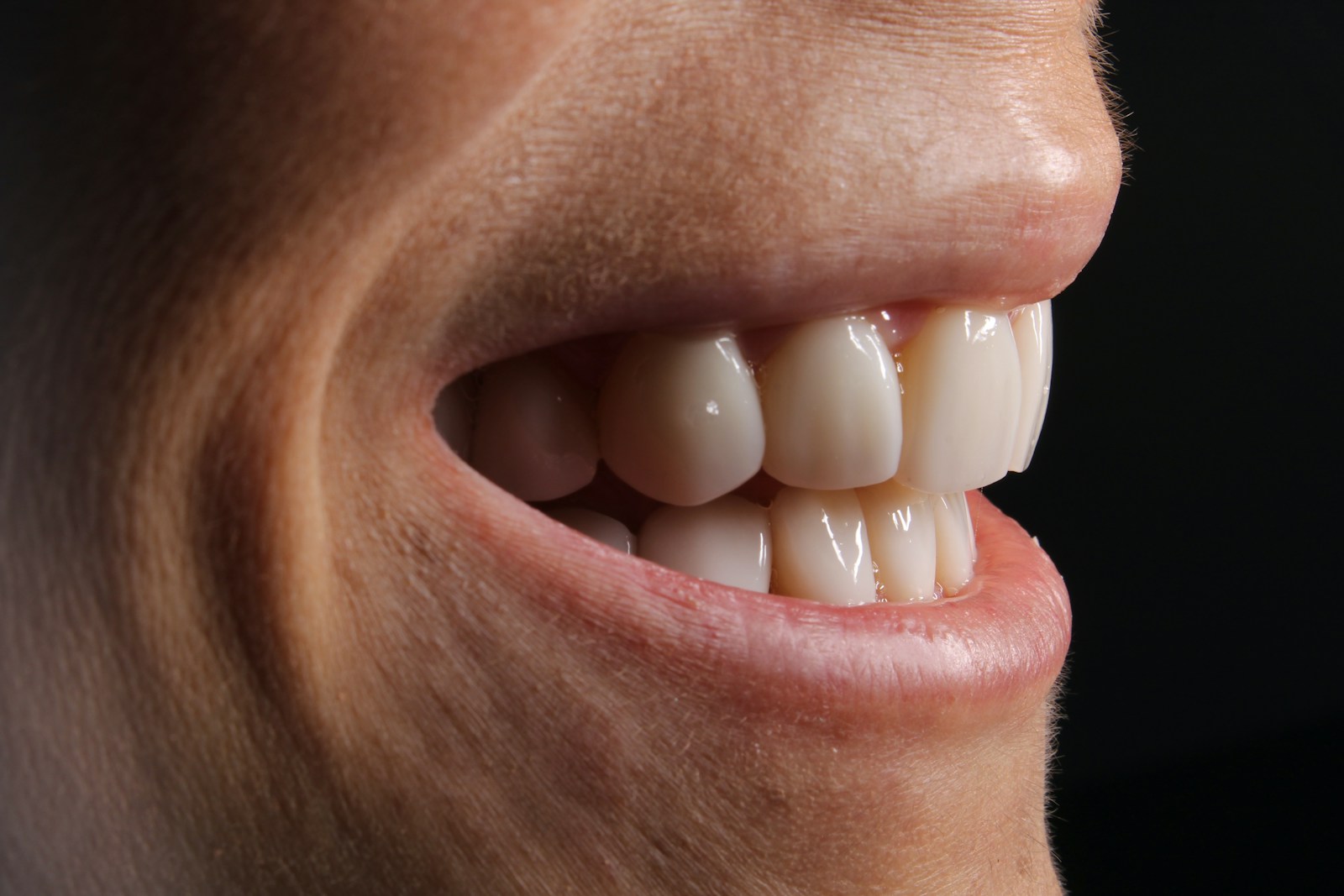 Close-up smile showing smooth, even veneers